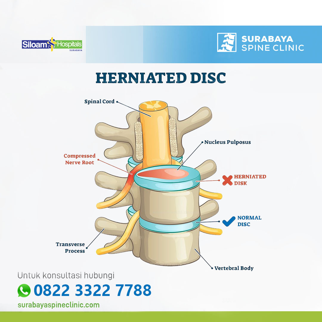 Memahami Herniated Nucleus Pulposis : Penyebab, Gejala dan Pilihan Perawatan